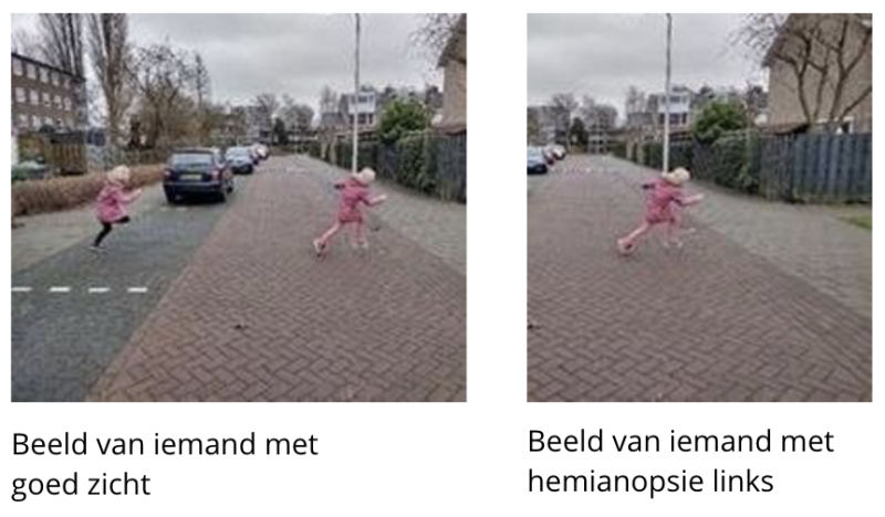 Twee foto's van dezelfde situatie. Op de eerste foto zien je twee kinderen een straat oversteken. Dat is het beeld van iemand met goed zicht. De tweede foto betreft dezelfde situatie, maar nu zie je alleen het voorste kind de straat oversteken. Dit is het beeld van iemand met hemianopsie links.